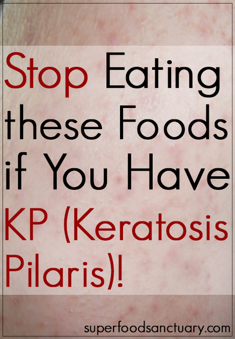 Keratosis pilaris (KP) is also known as ‘chicken skin.’ It mainly affects the upper arms, back of thighs, back of legs, buttocks, scalp and even the face. In this article, find out the list of foods to avoid if you have keratosis pilaris!